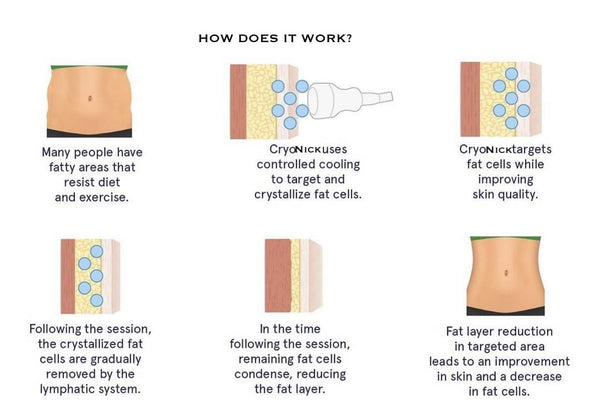 Vacuactivus Iceberg Cryonick Roller Mini- Body Shaper